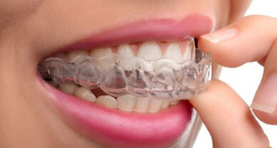 Invisalign Clear Braces - Courthouse Dental & Implants